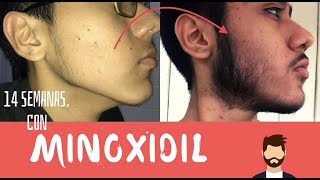 Barba con Minoxidil  14 semanas [upl. by Fayola]