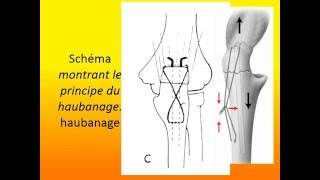 traumatologie FRACTURE DU L’OLÉCRANE [upl. by Grider]