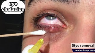 شاهد ازاي دمل العين بيتكون وازاي بنعالجةWhat is Chalazion [upl. by Middleton]