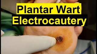 Treatment of Viral Warts  Electrocautery Procedure [upl. by Nosyd414]